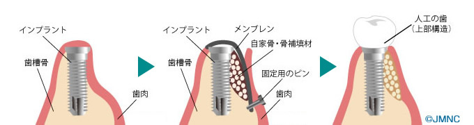 GBR(骨誘導再生法)