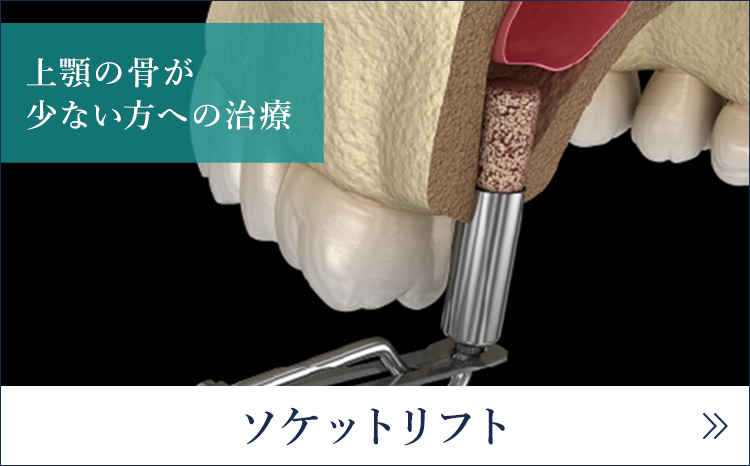 ソケットリフト