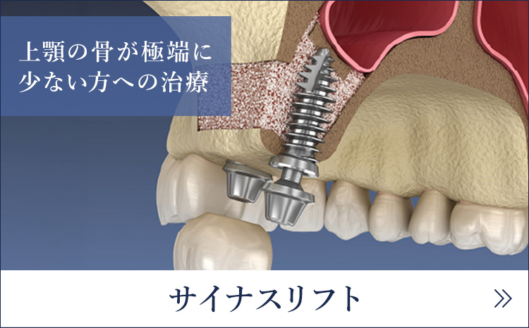 サイナスリフト