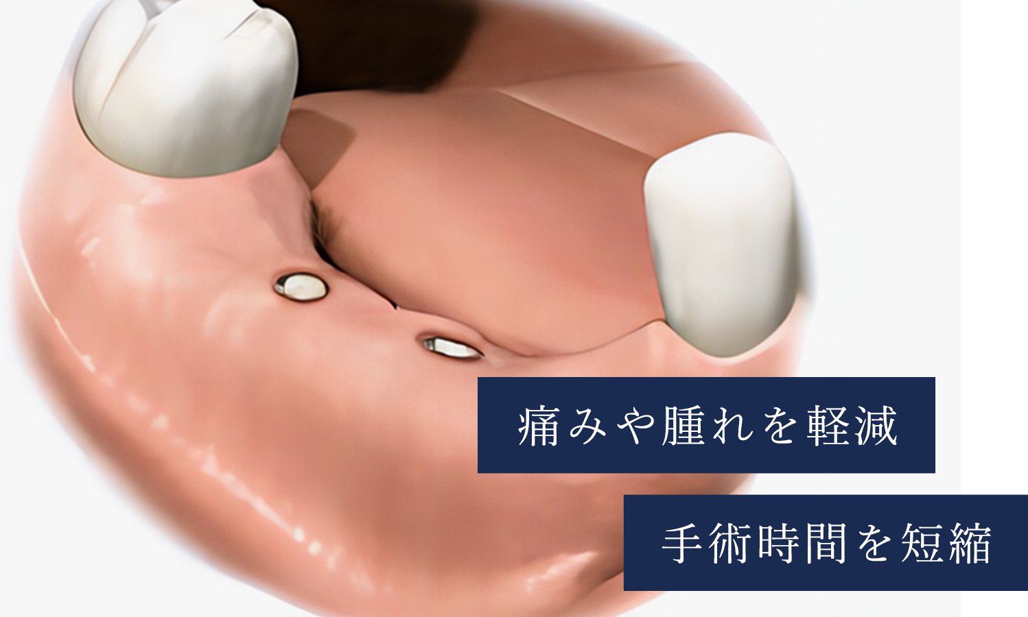 痛みや腫れを軽減手術時間を短縮